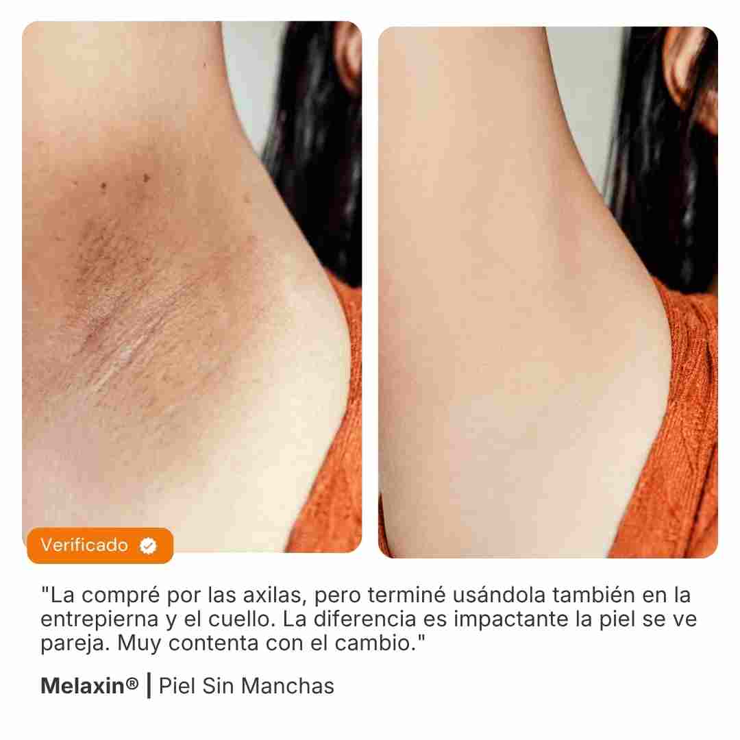 Melaxin® | Piel Sin Manchas